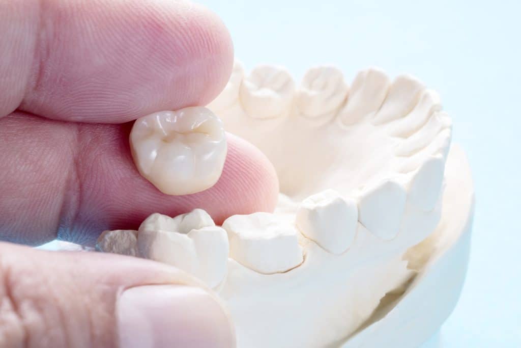 How Long Do Dental Crowns Last