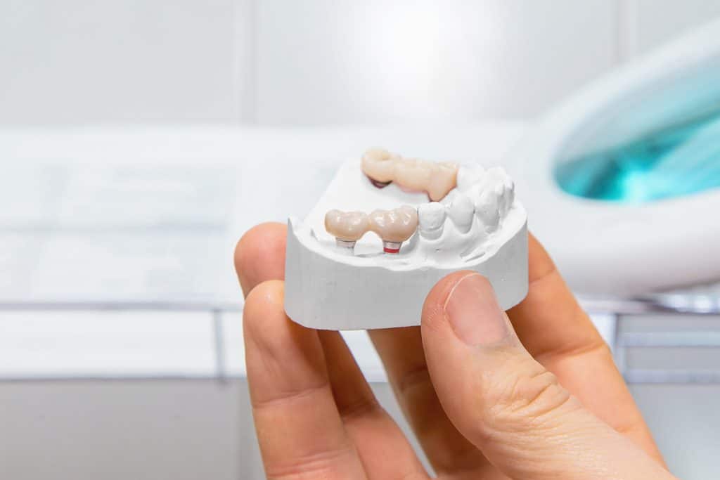 How Long Do Dental Bridges Last?